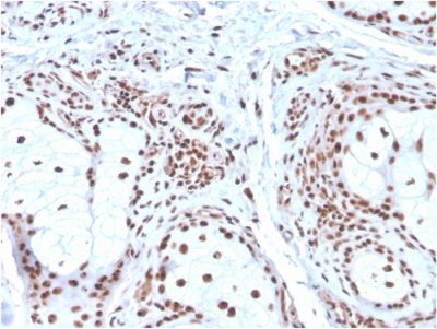 Formalin-fixed, paraffin-embedded human Basal Cell Carcinoma stained with Nucleophosmin Mouse Monoclonal Antibody (NPM1/3286).