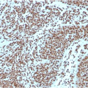 Formalin-fixed, paraffin-embedded human Basal Cell Carcinoma stained with Nucleophosmin-Monospecific Mouse Monoclonal Antibody (NPM1/3287).