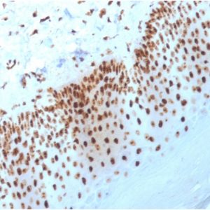 Formalin-fixed, paraffin-embedded human Basal Cell Carcinoma stained with Nucleophosmin Mouse Monoclonal Antibody (NPM1/3398).