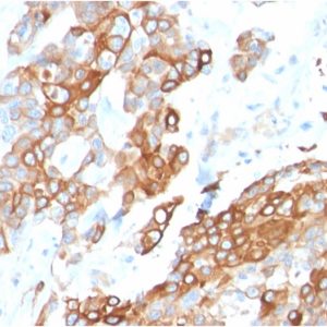 Formalin-fixed, paraffin-embedded human Breast Carcinoma stained with Heregulin-1 Mouse Monoclonal Antibody (NRG1/2710).