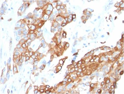 Formalin-fixed, paraffin-embedded human Breast Carcinoma stained with Heregulin-1 Mouse Monoclonal Antibody (NRG1/2710).