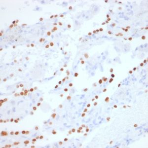 Formalin-fixed, paraffin-embedded human Lung Adenocarcinoma stained with TTF-1 Rabbit Recombinant Monoclonal Antibody (NX2.1/1855R).