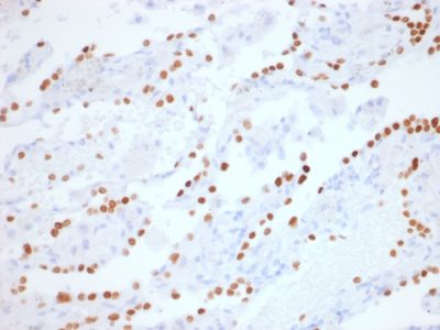 Formalin-fixed, paraffin-embedded human Lung Adenocarcinoma stained with TTF-1 Rabbit Recombinant Monoclonal Antibody (NX2.1/1855R).