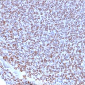 Formalin-fixed, paraffin-embedded human Ewing's Sarcoma stained with NKX2.2 Rabbit Recombinant Monoclonal Antibody (NX2/2198R).
