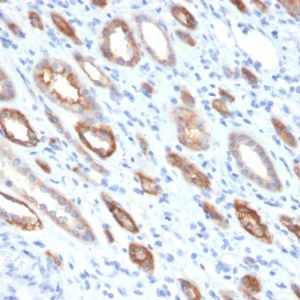 Formalin-fixed, paraffin-embedded human Renal Cell Carcinoma stained with Occludin Mouse Monoclonal Antibody (OCLN/2181).