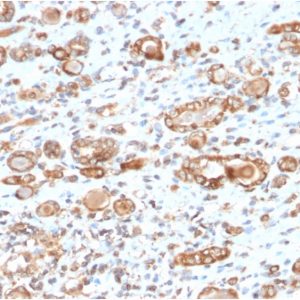 Formalin-fixed, paraffin-embedded human Renal Cell Carcinoma stained with HSP60 Mouse Monoclonal Antibody (CPTC-HSPD1-1).