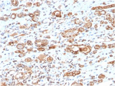 Formalin-fixed, paraffin-embedded human Renal Cell Carcinoma stained with HSP60 Mouse Monoclonal Antibody (CPTC-HSPD1-1).