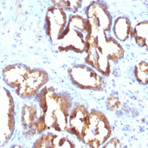 Formalin-fixed, paraffin-embedded human Prostate Carcinoma stained with PSAP Monoclonal Antibody (PASE/4LJ).