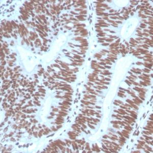 Formalin-fixed, paraffin-embedded human Colon Carcinoma stained with PAX2 Mouse Monoclonal Antibody (PAX2/1104).
