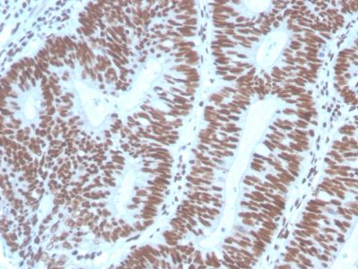 Formalin-fixed, paraffin-embedded human Colon Carcinoma stained with PAX2 Mouse Monoclonal Antibody (PAX2/1104).