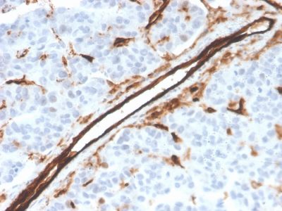 Formalin-fixed, paraffin-embedded human tumor of unknown origin stained with CD31 Mouse Monoclonal Antibody (PECAM1/3526).