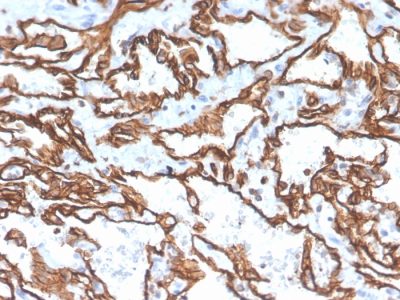 Formalin-fixed, paraffin-embedded human angiosarcoma stained with CD31 Mouse Monoclonal Antibody (PECAM1/3529).