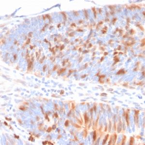 Formalin-fixed, paraffin-embedded human colon stained with Methyl-CpG Binding Domain Protein 1 Mouse Monoclonal Antibody (CPTC-MBD1-1)