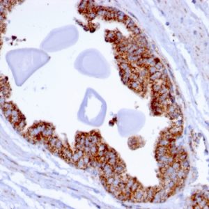 Formalin-fixed, paraffin-embedded human Prostate Carcinoma stained with PMEPA1 Mouse Monoclonal Antibody (PMEPA1/2696).