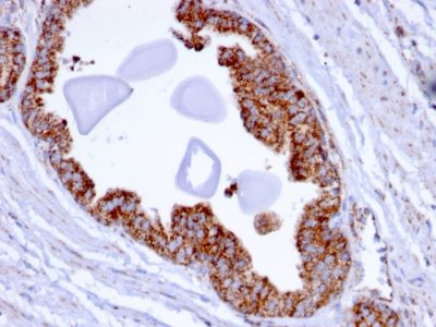 Formalin-fixed, paraffin-embedded human Prostate Carcinoma stained with PMEPA1 Mouse Monoclonal Antibody (PMEPA1/2696).