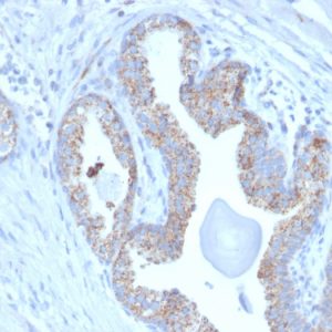 Formalin-fixed, paraffin-embedded human Prostate Carcinoma stained with PMEPA1 Mouse Monoclonal Antibody (PMEPA1/2697).