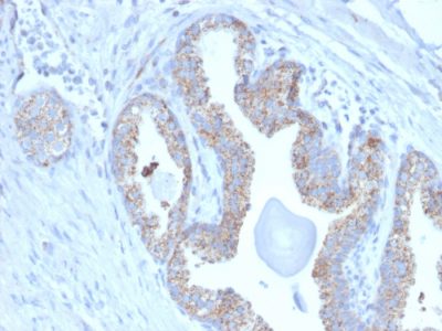 Formalin-fixed, paraffin-embedded human Prostate Carcinoma stained with PMEPA1 Mouse Monoclonal Antibody (PMEPA1/2697).