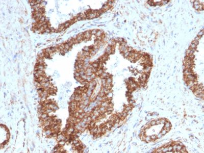 Formalin-fixed, paraffin-embedded human Prostate Carcinoma stained with PMEPA1 Mouse Monoclonal Antibody (PMEPA1/2698).