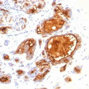Formalin-fixed, paraffin-embedded human Breast Carcinoma stained with MUC1 Mouse Monoclonal Antibody (115D8).