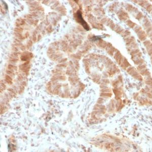 Formalin-fixed, paraffin-embedded human colon carcinoma stained with AKT1 Recombinant Mouse Monoclonal Antibody (rAKT1/2491).