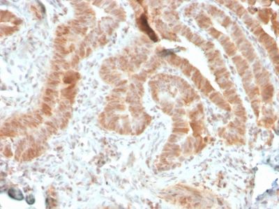 Formalin-fixed, paraffin-embedded human colon carcinoma stained with AKT1 Recombinant Mouse Monoclonal Antibody (rAKT1/2491).