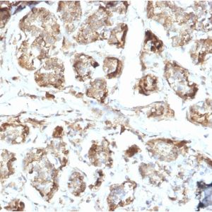 Formalin-fixed, paraffin-embedded human Breast Carcinoma stained with NME2 / nm23-H2 Mouse Monoclonal Antibody (CPTC-NME2-2).