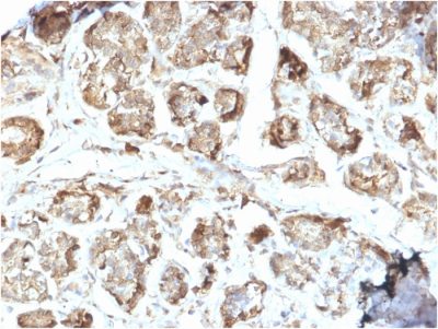 Formalin-fixed, paraffin-embedded human Breast Carcinoma stained with NME2 / nm23-H2 Mouse Monoclonal Antibody (CPTC-NME2-2).