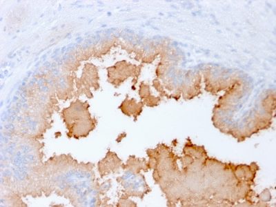 Formalin-fixed, paraffin-embedded human Prostate Carcinoma stained with AMACR Recombinant Mouse Monoclonal Antibody (rAMACR/1864).