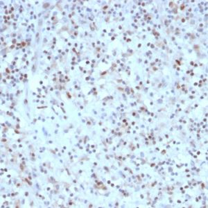 Formalin-fixed, paraffin-embedded human Hodgkins Lymphoma stained with BCL-6 Mouse Recombinant Monoclonal Antibody (rBCL6/1527).