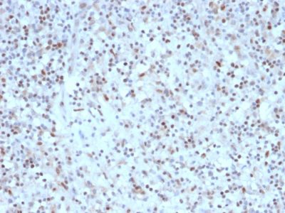 Formalin-fixed, paraffin-embedded human Hodgkins Lymphoma stained with BCL-6 Mouse Recombinant Monoclonal Antibody (rBCL6/1527).