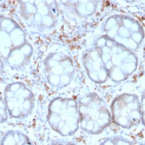 Formalin-fixed, paraffin-embedded human Colon Carcinoma stained with CD209 Mouse Monoclonal Antibody (rC209/1781).