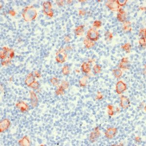 Formalin-fixed, paraffin-embedded human Hodgkin's lymphoma stained with CD30 Mouse Recombinant Monoclonal Antibody (rCD30/412).