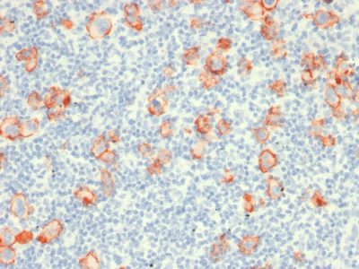 Formalin-fixed, paraffin-embedded human Hodgkin's lymphoma stained with CD30 Mouse Recombinant Monoclonal Antibody (rCD30/412).