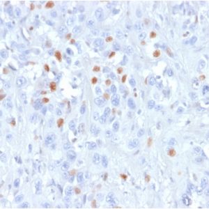 Formalin-fixed, paraffin-embedded human Urothelial carcinoma stained with p21 Mouse Recombinant Monoclonal Antibody (rCIP1/823).