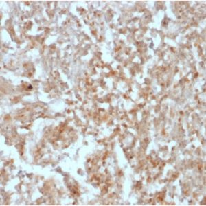 Formalin-fixed, paraffin-embedded human GIST stained with DOG-1 Mouse Recombinant Monoclonal Antibody (rDG1/447).