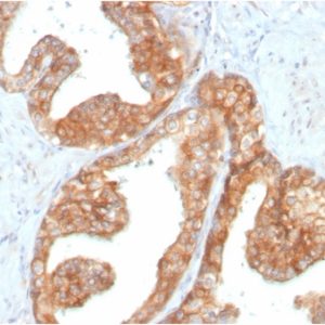 Formalin-fixed, paraffin-embedded human Prostate Carcinoma stained with RET Mouse Monoclonal Antibody (RET/2795).