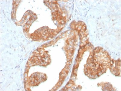 Formalin-fixed, paraffin-embedded human Prostate Carcinoma stained with RET Mouse Monoclonal Antibody (RET/2795).