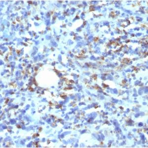 Formalin-fixed, paraffin-embedded human Histiocytoma stained with CD68 Recombinant Mouse Monoclonal Antibody (rLAMP4/824).