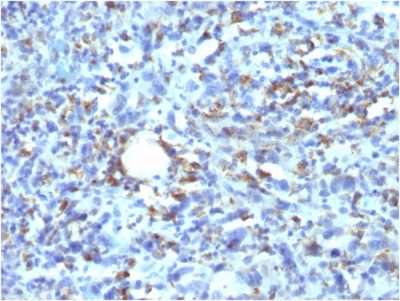 Formalin-fixed, paraffin-embedded human Histiocytoma stained with CD68 Recombinant Mouse Monoclonal Antibody (rLAMP4/824).