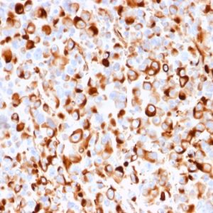 Formalin-fixed, paraffin-embedded human Melanoma stained with NGFR Mouse Recombinant Monoclonal Antibody (rNGFR/1965).
