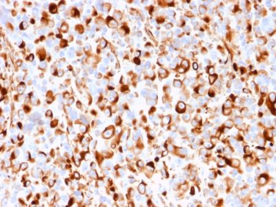 Formalin-fixed, paraffin-embedded human Melanoma stained with NGFR Mouse Recombinant Monoclonal Antibody (rNGFR/1965).