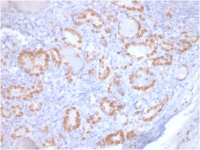 Formalin-fixed, paraffin-embedded human Lung Adenocarcinoma stained with TTF-1 Mouse Recombinant Monoclonal Antibody (rNX2.1/690).
