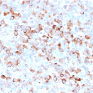 Formalin-fixed, paraffin-embedded Melanoma stained with Tyrosinase Mouse Recombinant Monoclonal Antibody (rOCA1/812).
