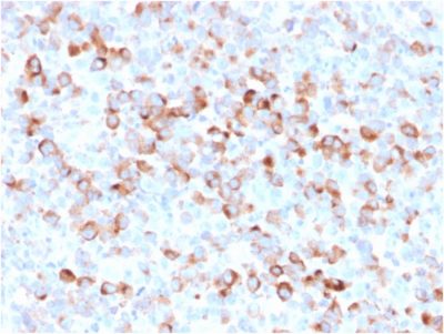 Formalin-fixed, paraffin-embedded Melanoma stained with Tyrosinase Mouse Recombinant Monoclonal Antibody (rOCA1/812).