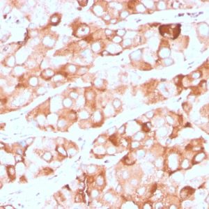 Formalin-fixed, paraffin-embedded human breast carcinoma stained with Prolactin Receptor Recombinant Mouse Monoclonal Antibody (rPRLR742).