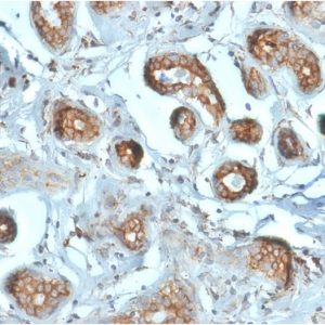 Formalin-fixed, paraffin-embedded human Breast Carcinoma stained with Laminin Receptor Monospecific Mouse Monoclonal Antibody (RPSA/2699).