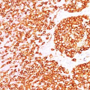 Formalin-fixed, paraffin-embedded human Tonsil stained with CD45 Mouse Recombinant Monoclonal Antibody (rPTPRC/1460).