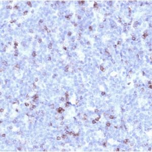 Formalin-fixed, paraffin-embedded human Lymphoma stained with CD43 Mouse Recombinant Monoclonal Antibody (rSPN/1094).