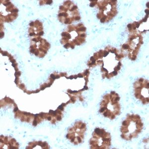 Formalin-fixed, paraffin-embedded human Breast Carcinoma stained with TFF1/pS2 Mouse Monoclonal Antibody (rTFF1/1091).