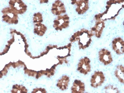 Formalin-fixed, paraffin-embedded human Breast Carcinoma stained with TFF1/pS2 Mouse Monoclonal Antibody (rTFF1/1091).